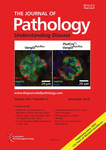 Single‐cell sequencing defines genetic heterogeneity in pancreatic cancer precursor lesions