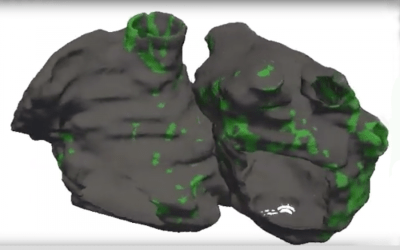 Personalized simulations lead to more accurate, successful treatment for common heart rhythm disorder